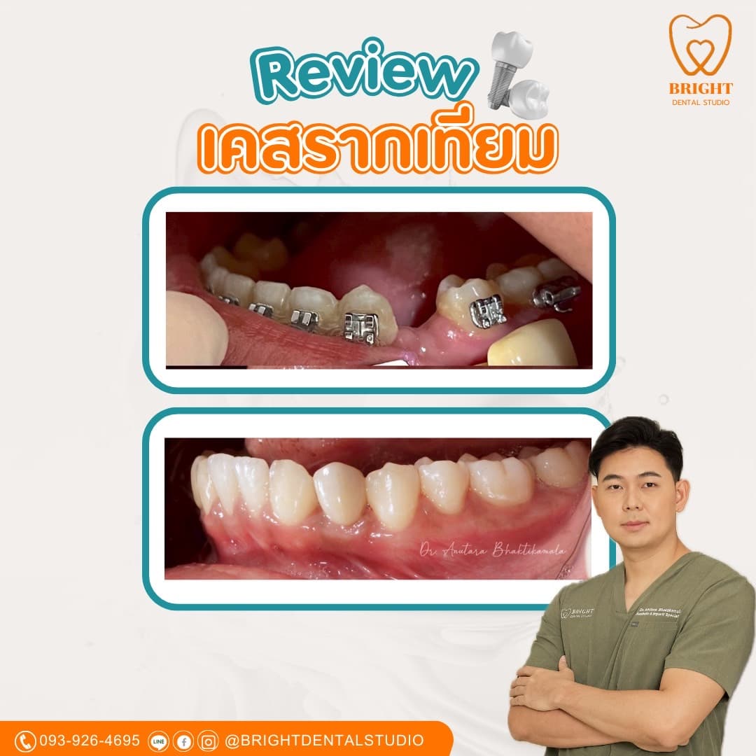implant 2