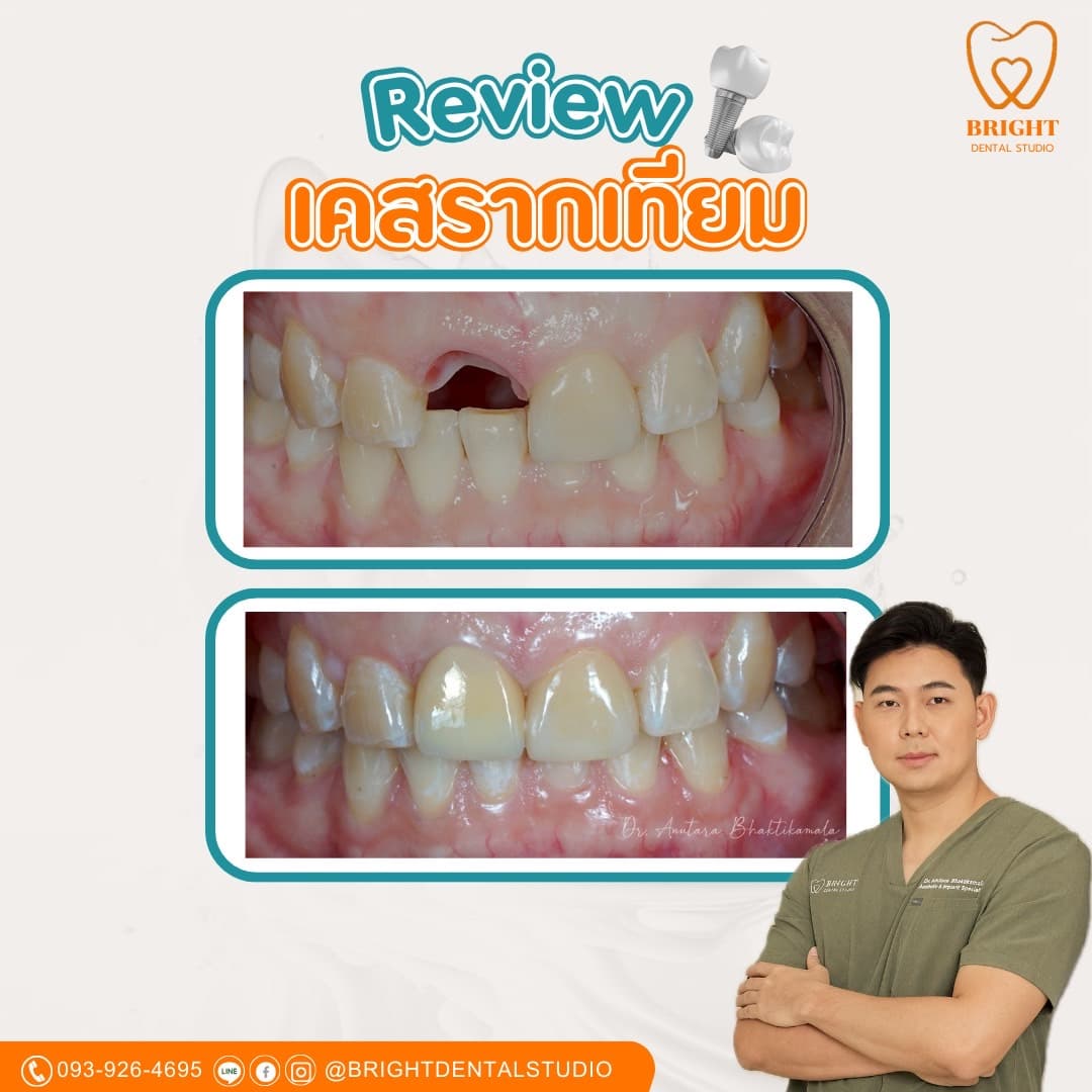 implant 3
