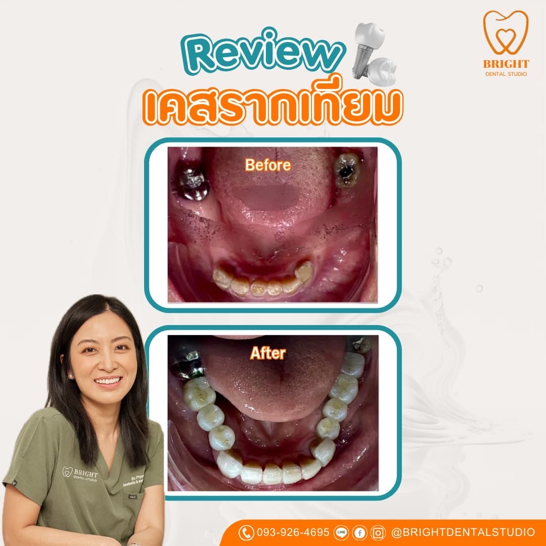 implant 4