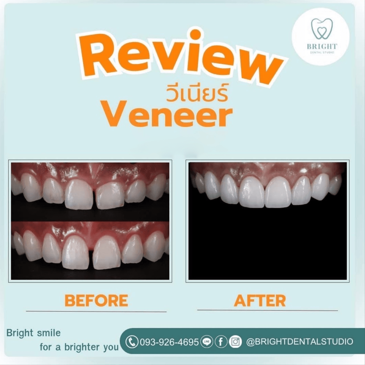 veneer 3
