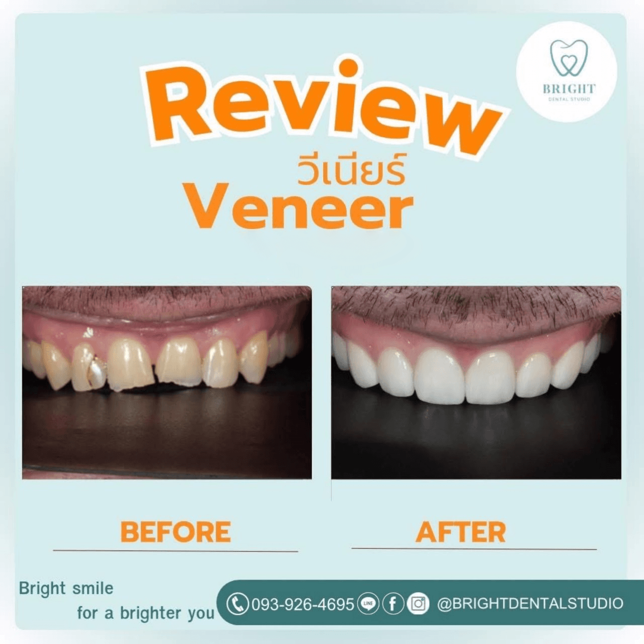 veneer 4