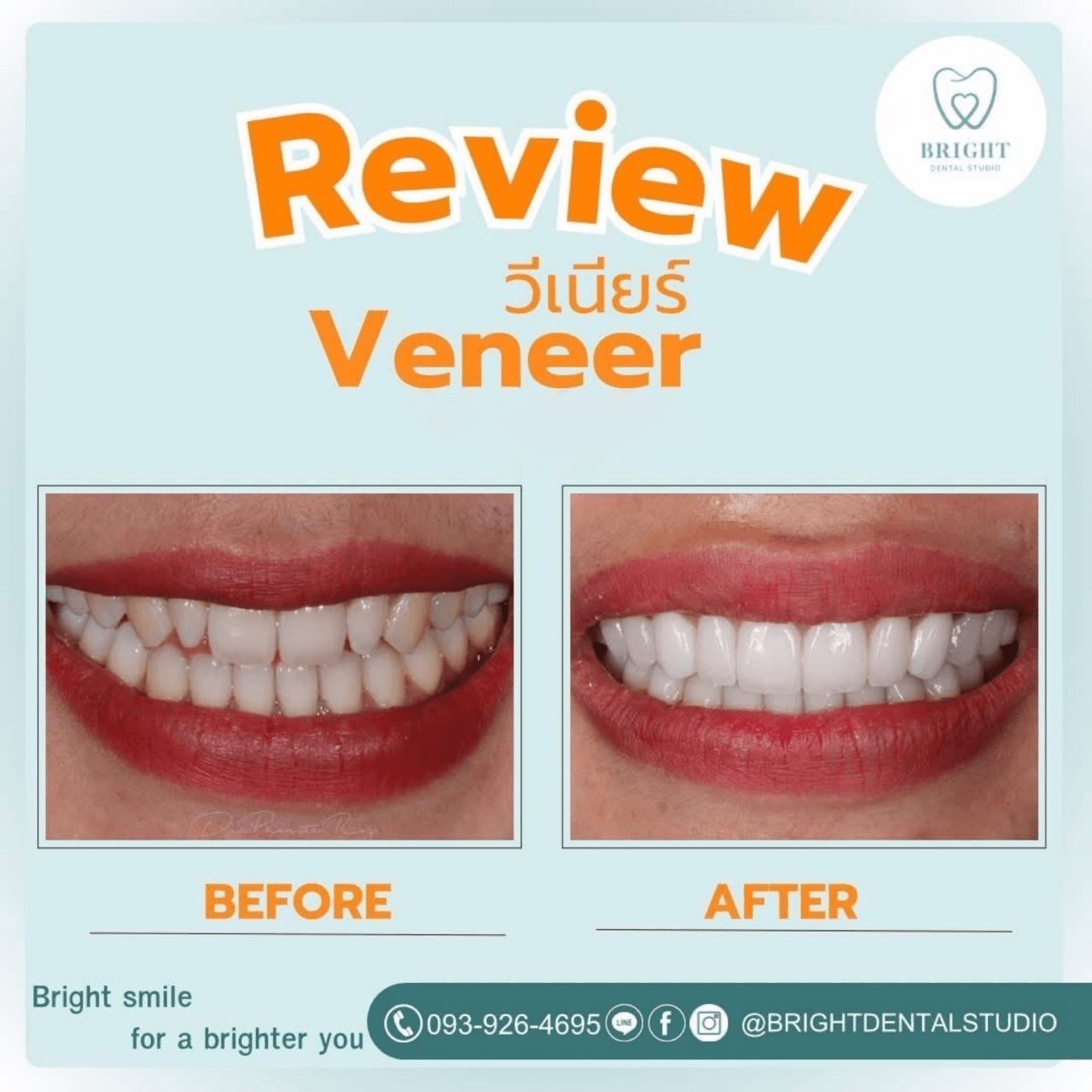 veneer 5