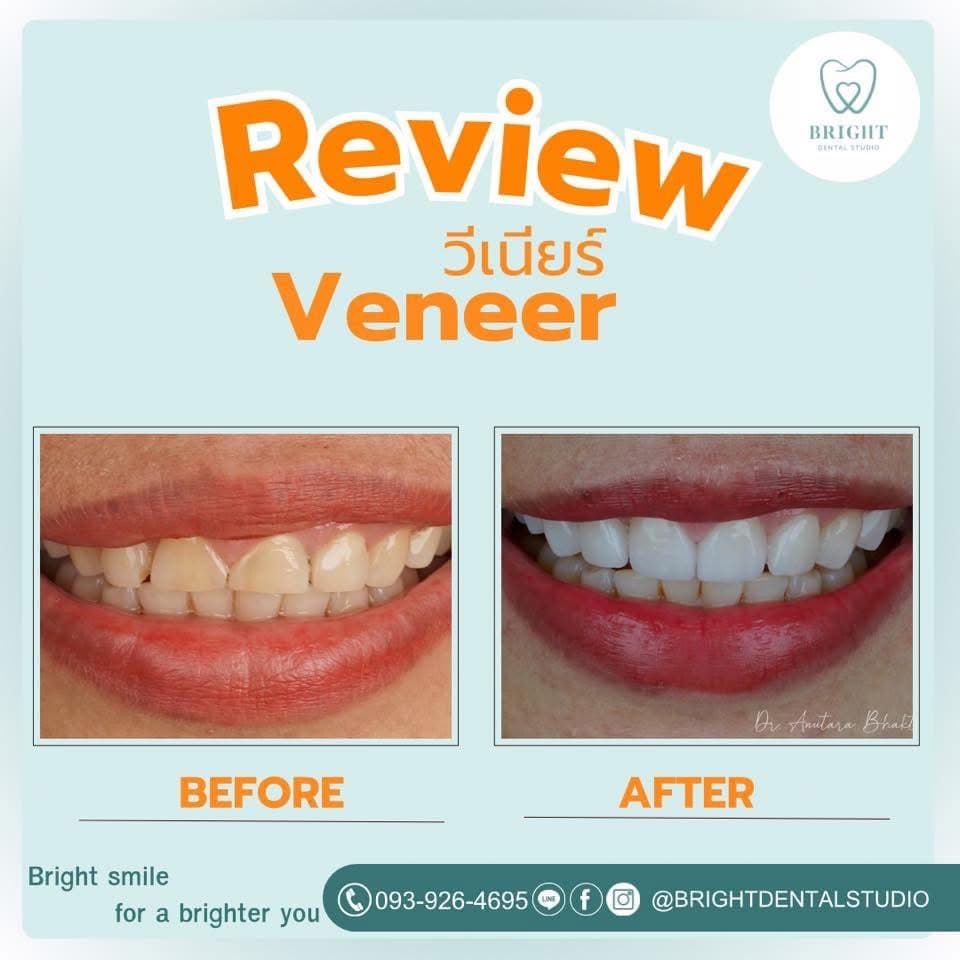 veneer 6
