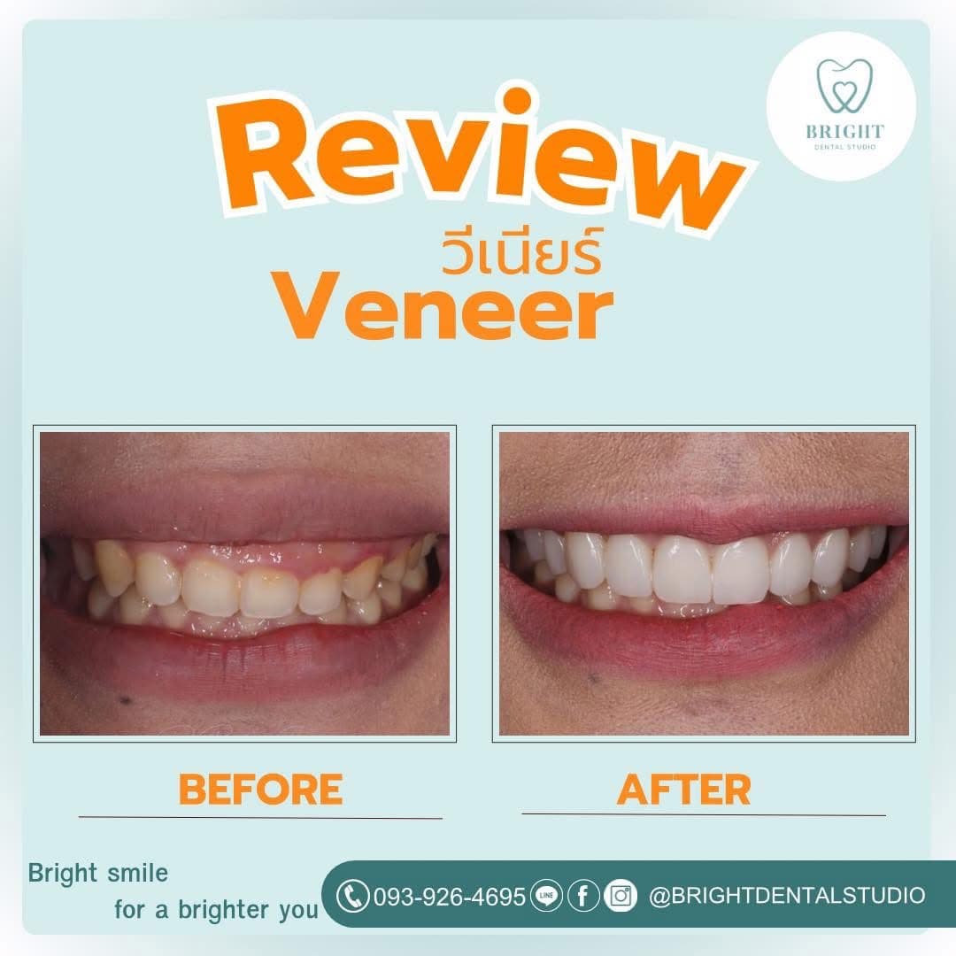 veneer 7