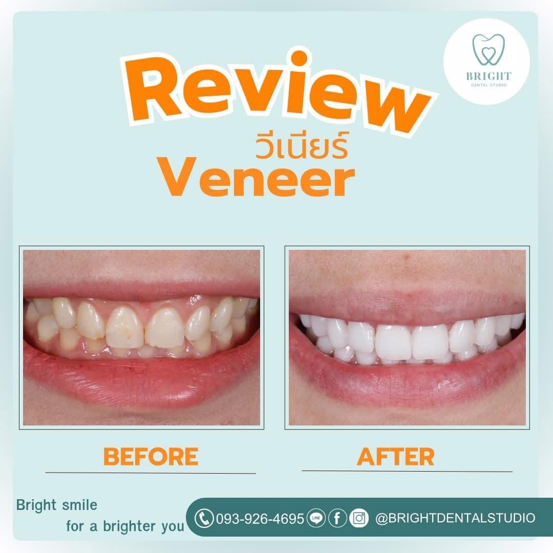 veneer 8